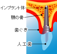 インプラント