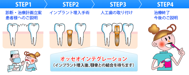 一回法によるインプラント治療手順