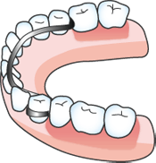 入れ歯による治療