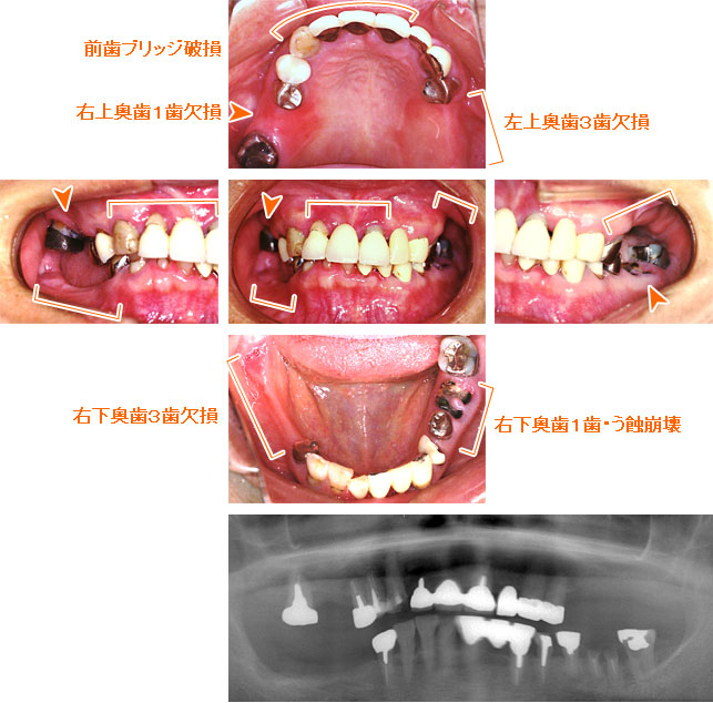 インプラント治療例１０