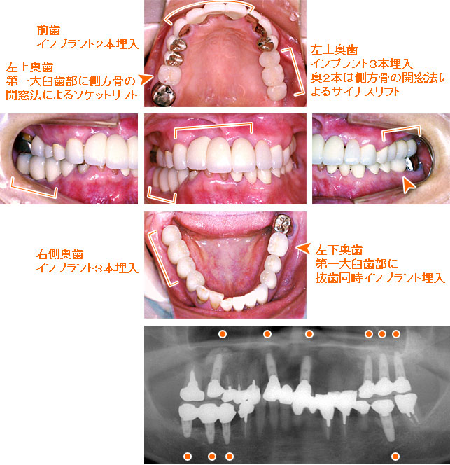 インプラント治療例１０