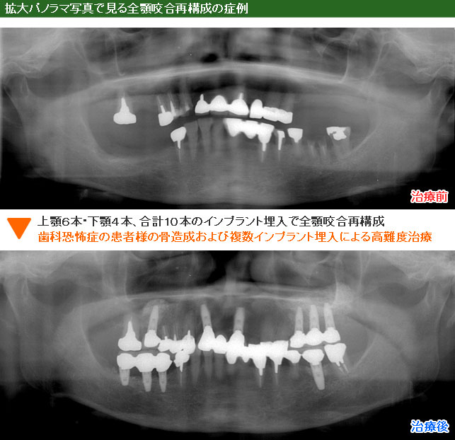 インプラント治療例１０