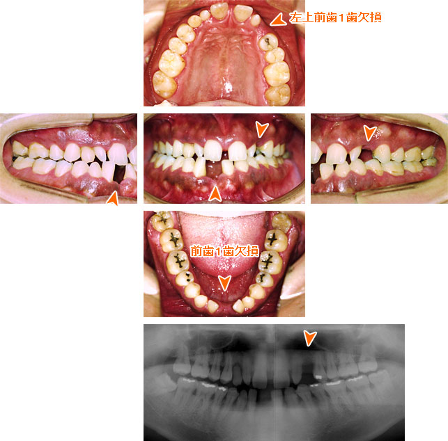 インプラント治療例１１