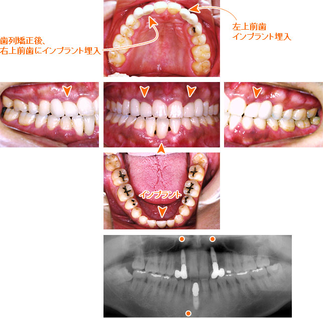 インプラント治療例１１