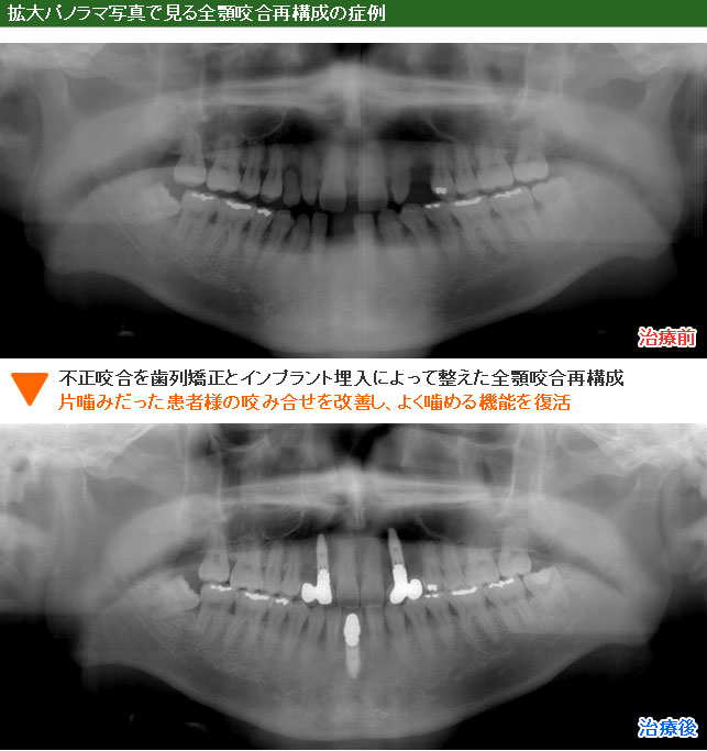 インプラント治療例１１