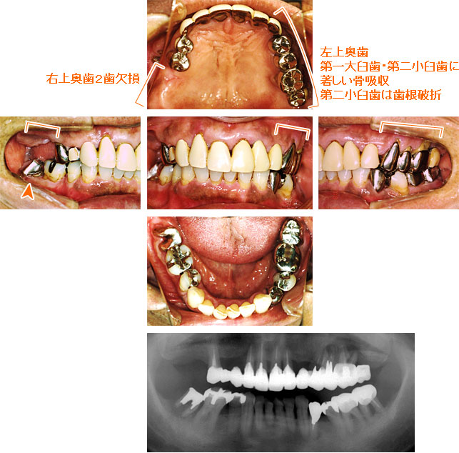 インプラント治療例１２