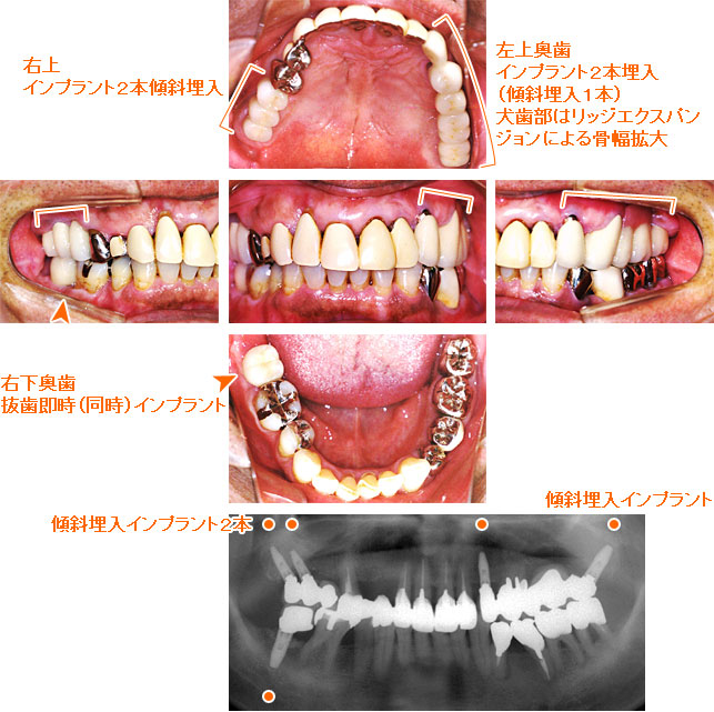 インプラント治療例１２