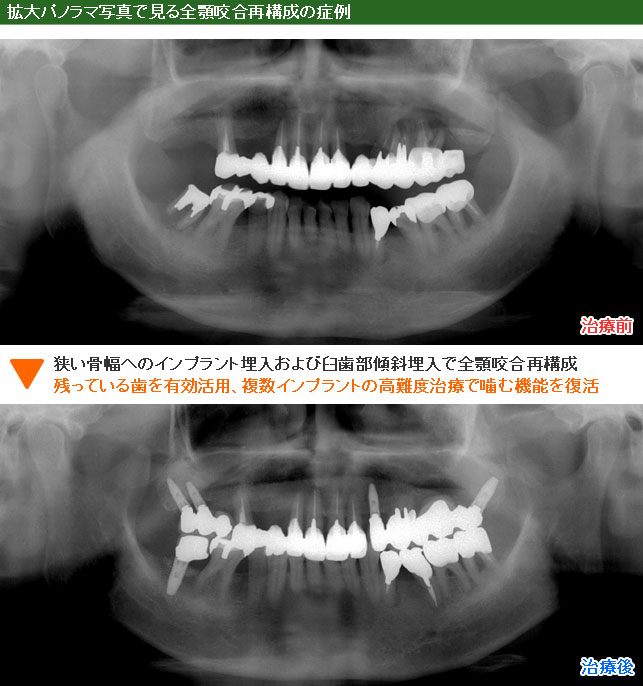 インプラント治療例１２