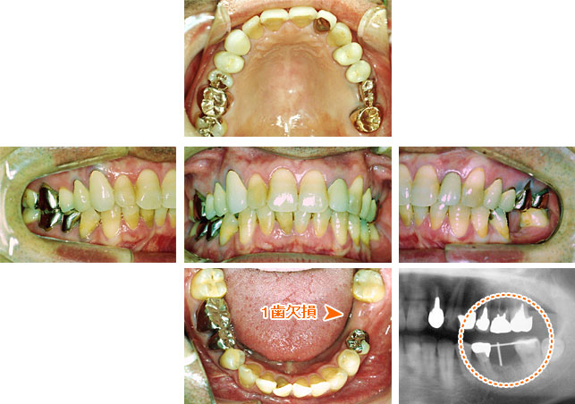 インプラント治療例１ － インプラント１本で噛む機能を再現（治療前）