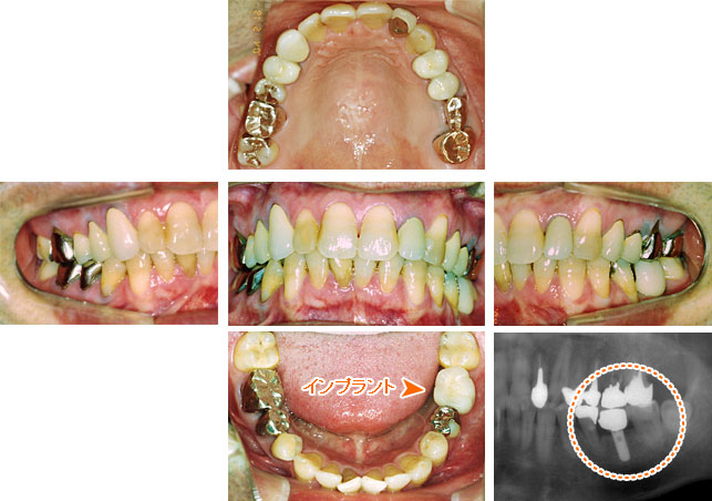 インプラント治療例１ － インプラント１本で噛む機能を再現（治療後）