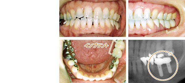 インプラント治療例２