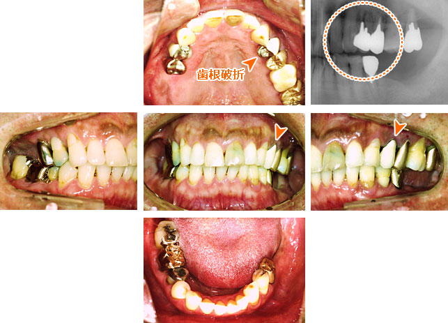 インプラント治療例３