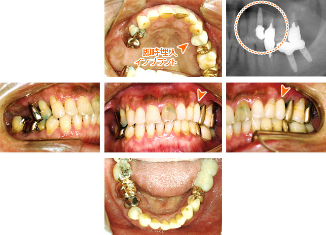 インプラント治療例３