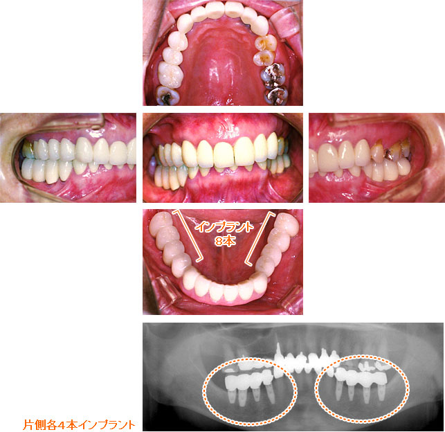 インプラント治療例４