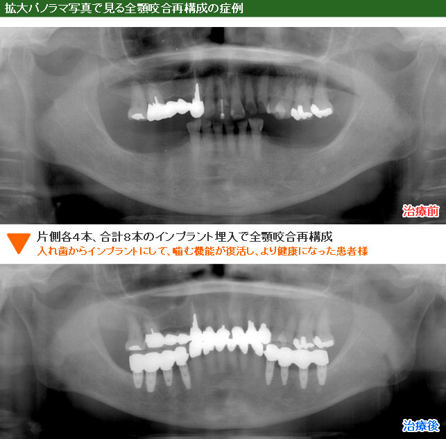 拡大パノラマ写真で見るインプラント治療による全顎咬合再構成の症例