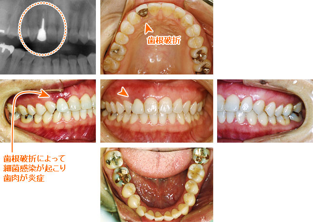インプラント治療例５
