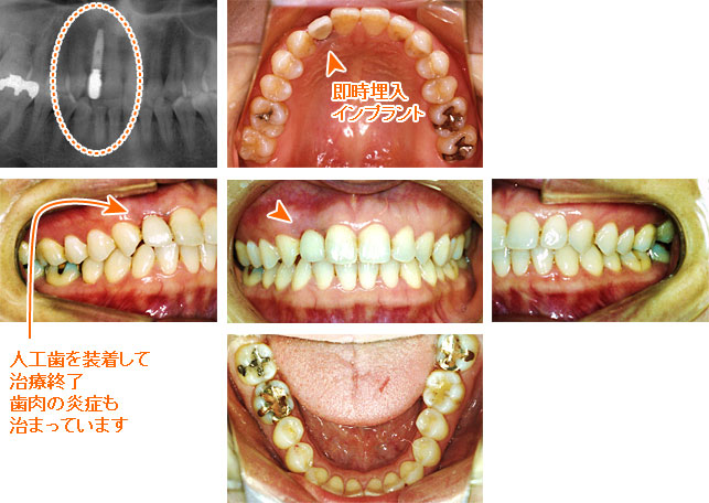 インプラント治療例５