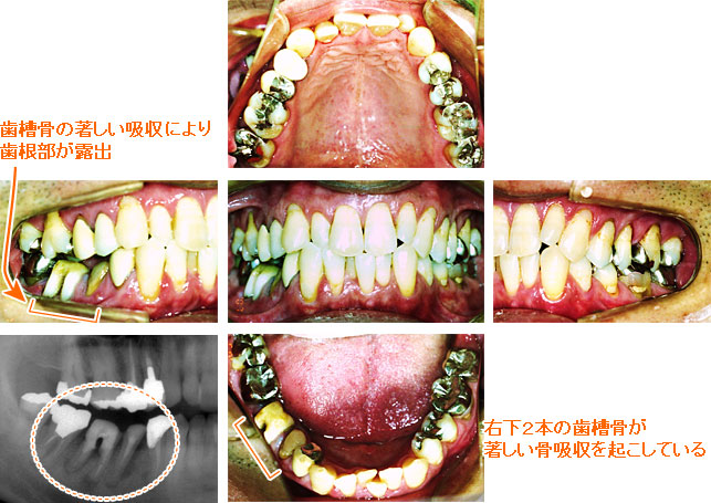 インプラント治療例６