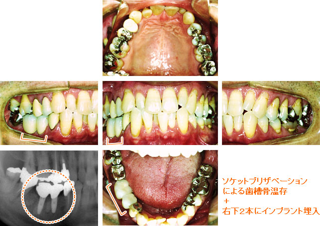 インプラント治療例６