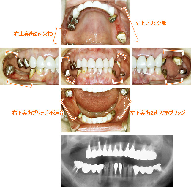 インプラント治療例７