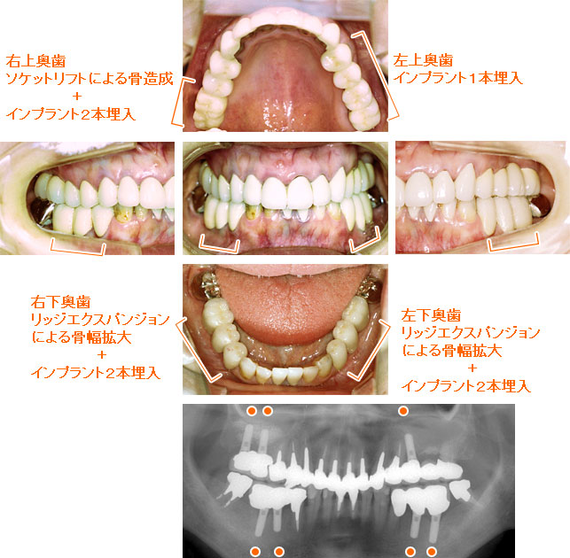 インプラント治療例７