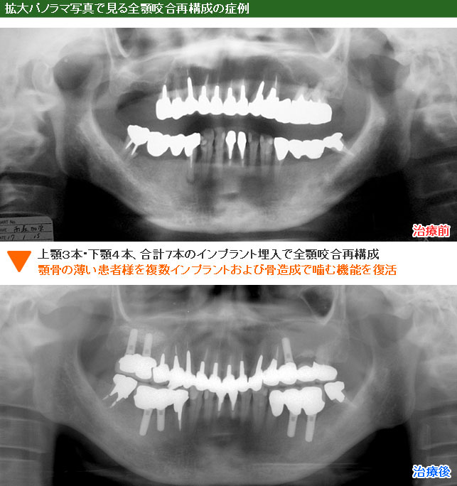 インプラント治療例７