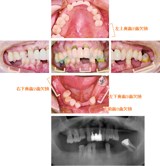 インプラント治療例８