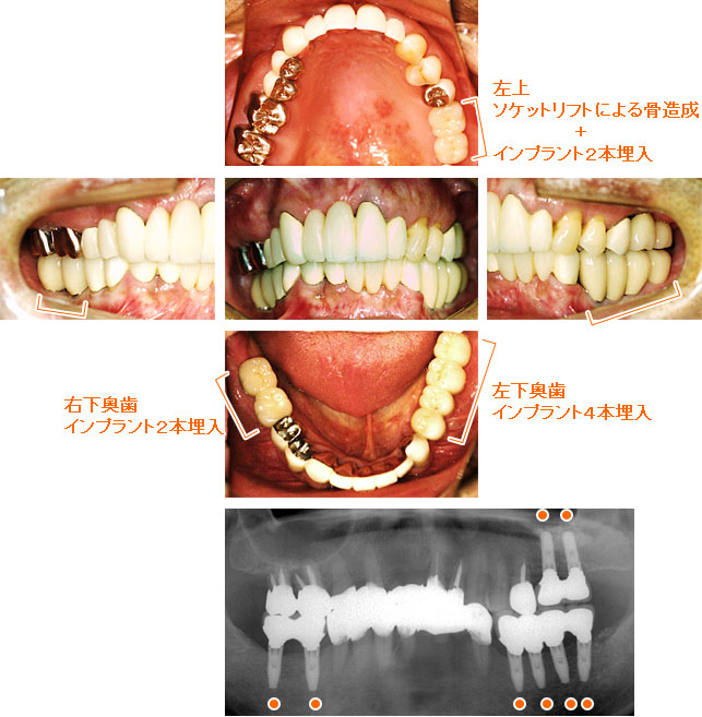 インプラント治療例８