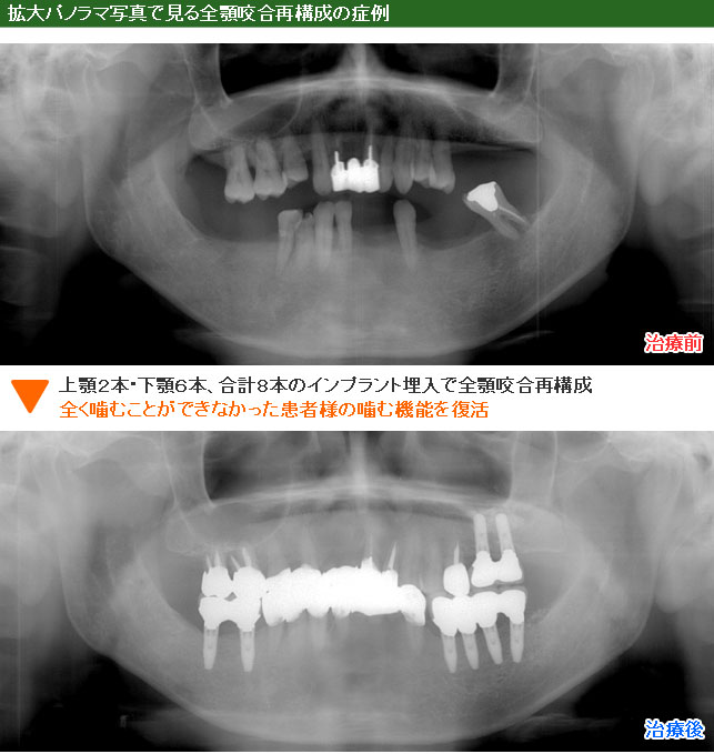 インプラント治療例８