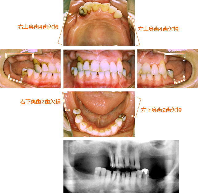 インプラント治療例９