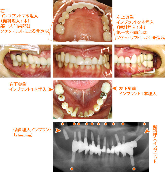 インプラント治療例９