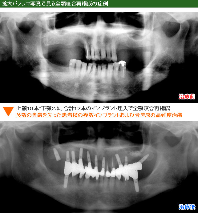 インプラント治療例９