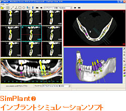 SimPlant(R)インプラントシミュレーションソフト