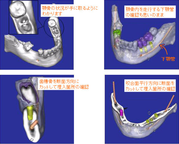 ＣＴ断層撮影