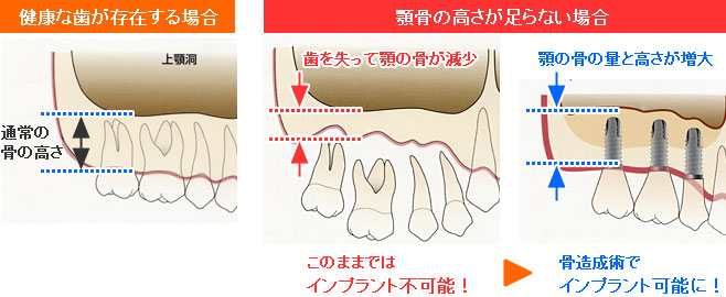 インプラント治療を可能にする骨造成手術