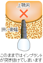 このままではインプラント治療ができません