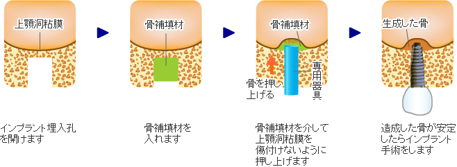 上顎洞底挙上術 － ソケットリフト（非開窓法）