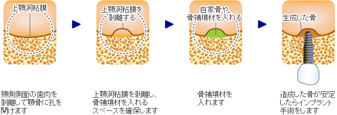 上顎洞底挙上術 － サイナスリフト（開窓法）