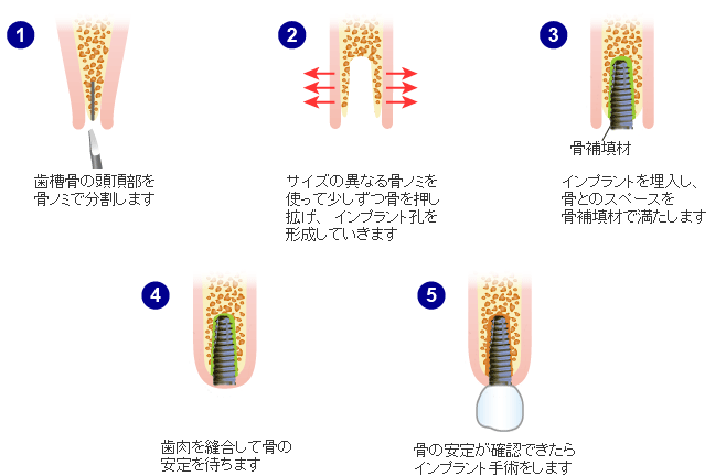 リッジエキスパンジョン（スプリットクレスト法）