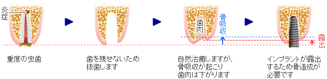 このままではインプラント治療ができません