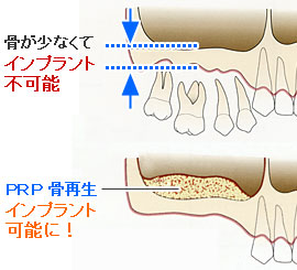 ＰＲＰ（多血小板血漿）骨再生療法