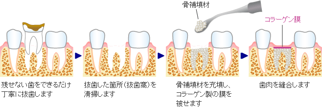 ソケットブリザベーション - 歯槽堤温存を考慮した抜歯術