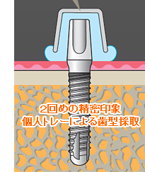 １回めの印象採得（概形印象）